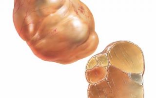 Признаки и методы лечения муцинозной кисты