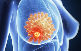 Рак молочной железы: симптомы, диагностика и лечение