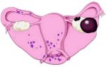 Проявления и лечение эндометриоидной кисты яичника