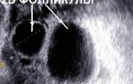 Причины развития двух доминантных фолликулов в яичнике