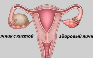 Причины развития и лечение гормонального новообразования