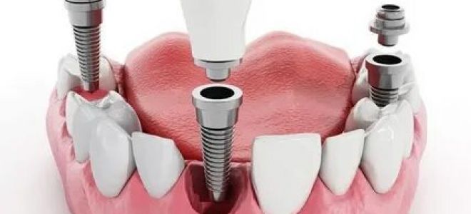 В каких случаях нужна имплантация зубов?