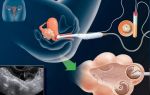 Подготовка и особенности проведения пункции яичника