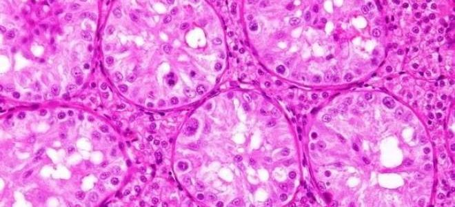 Особенности проведения гистологии кисты яичника после оперативного вмешательства