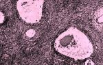 Характеристика и размеры аденофибриомы яичника