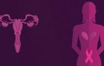 Семейный рак яичников и молочной железы: как понять риск и что с ним делать