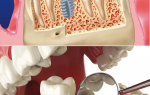 От чего зависит стоимость на имплантацию зубов?