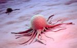 Перерождение доброкачественного образования яичника в раковую опухоль