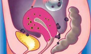 Развитие и лечение аденомиоза яичников