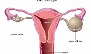 Характеристика и причины возникновения кисты на яичнике