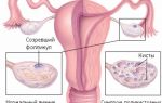 Лечение и признаки склерокистоза яичников у женщин