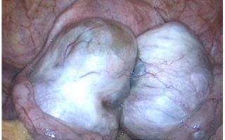 Двусторонние эндометриоидные кисты яичника или рак: как определить