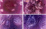Особенности развития и виды опухолевидных образований яичников