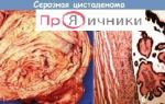 Офтальмогипертензия глаза: что это и почему важно обратить на это внимание?