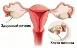 Каковы причины возникновения кисты яичников у женщин