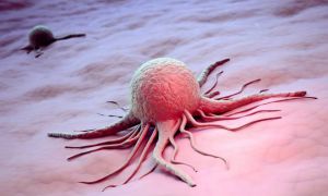 Перерождение доброкачественного образования яичника в раковую опухоль