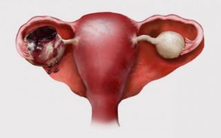 Разрыв яичника у женщины, как и почему